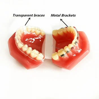 5gab Zobu Neredzams Ortodontijas Modeli Metāla Skavām, Pārskatāmu Salīdzinājumu Modeli, Zobārsts Lab